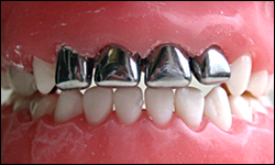 Stainless Steel Crowns