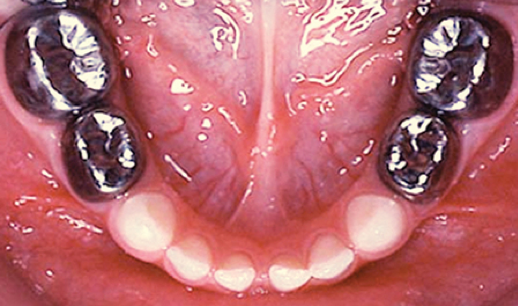 prefabricated-crowns-for-primary-molars-scottish-dental-magazine